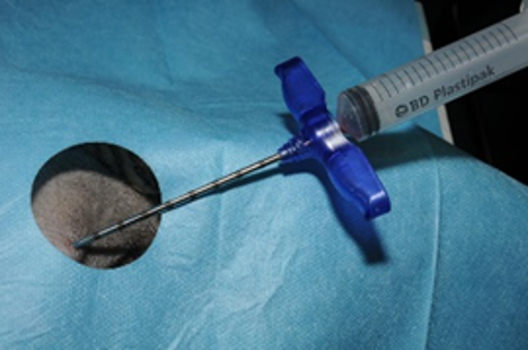 Bone Marrow Biopsy