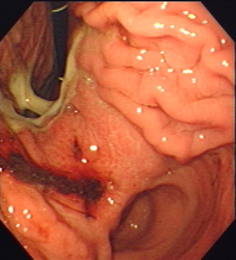 Outpatient Endoscopy