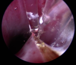 In this image the ureter has been catheterised and a laser is being used to dissect along the wall of the ureter.